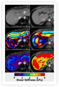 MRI image on right shows liver stiffness.